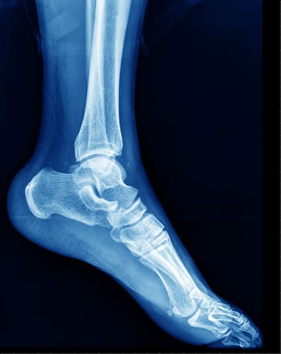 foot Xray